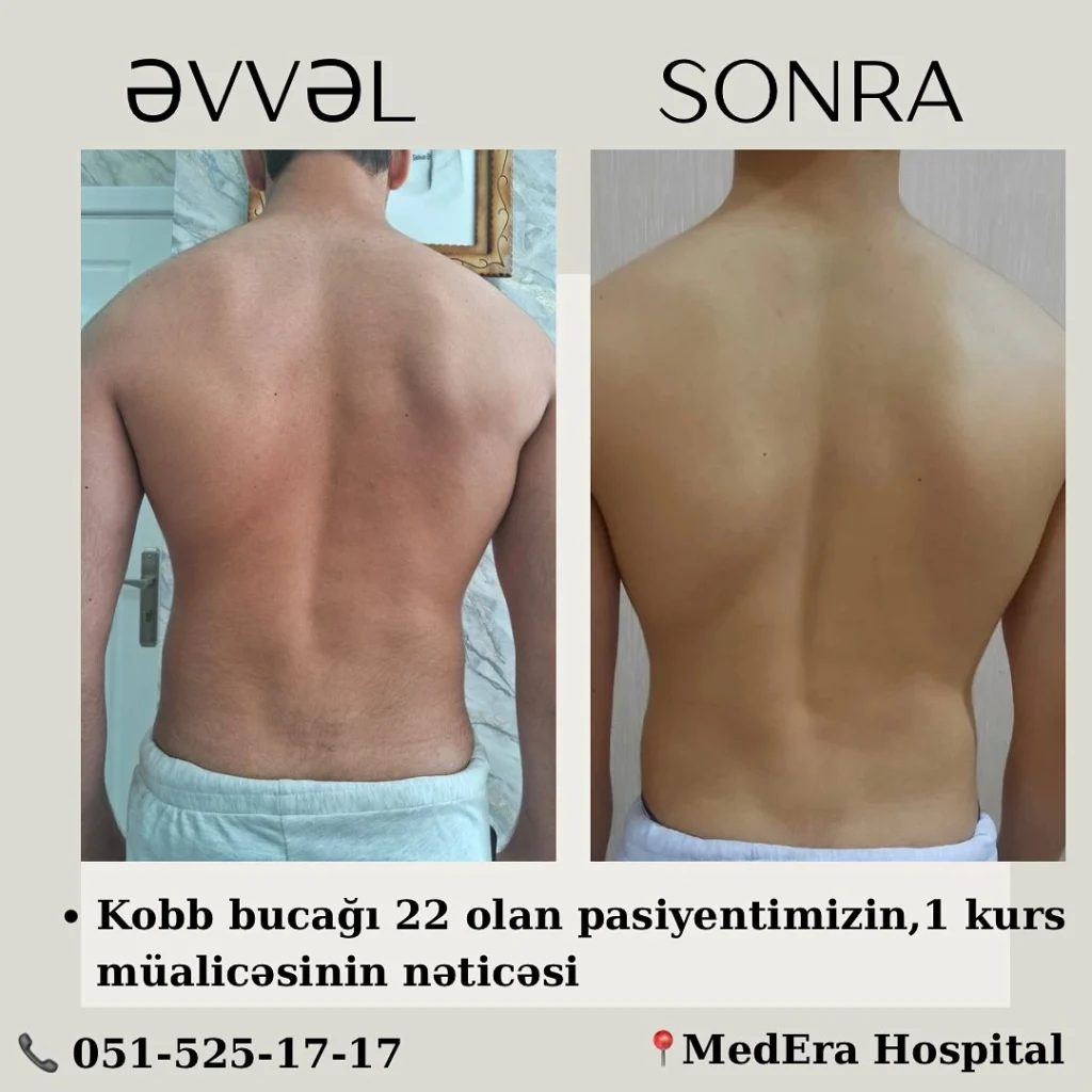 skoliozun müalicəsi