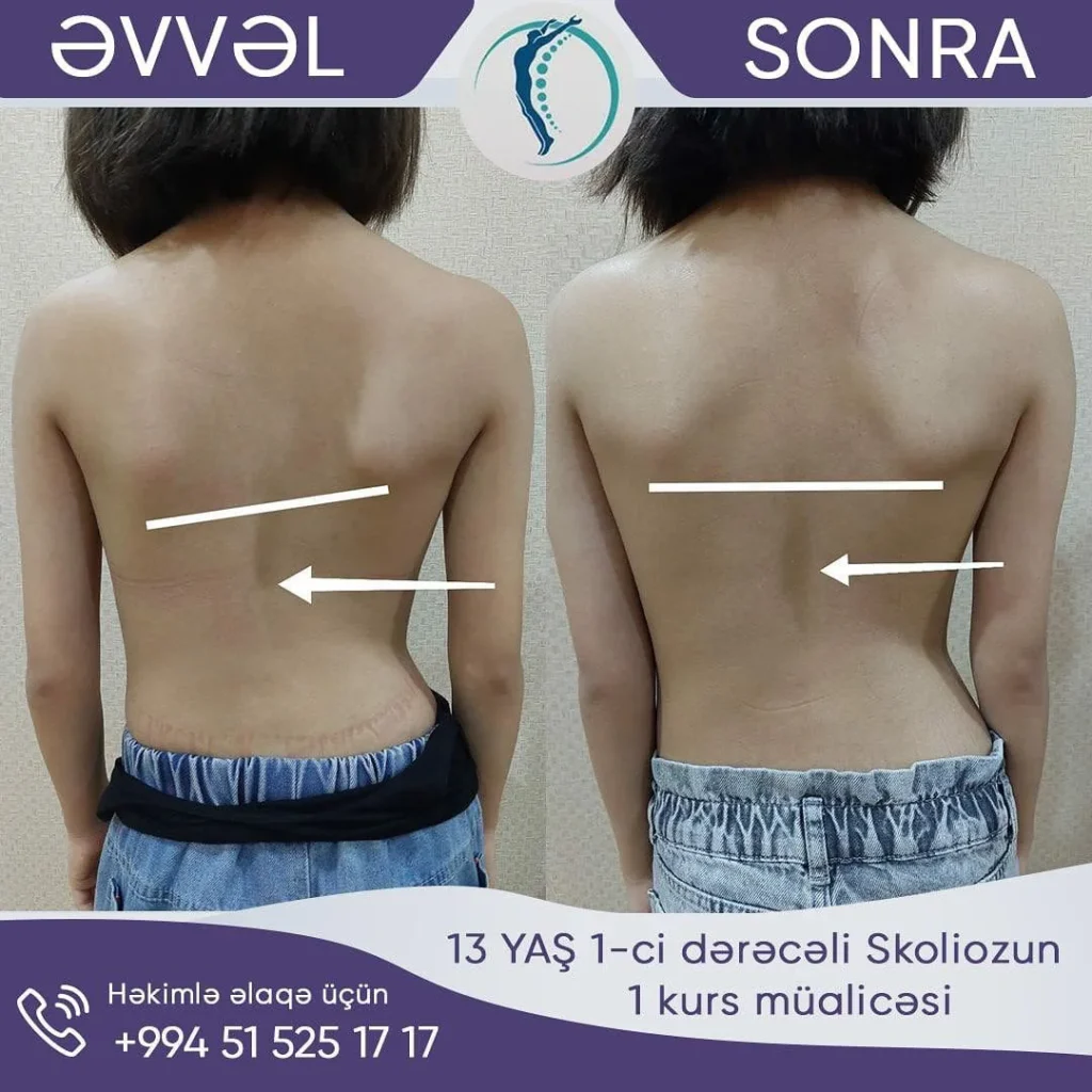 skolioz müalicəsi