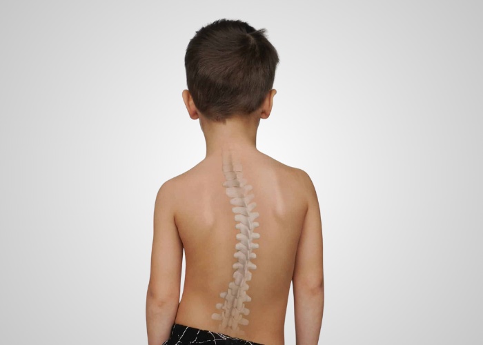 uşaqlarda skolioz müalicəsi