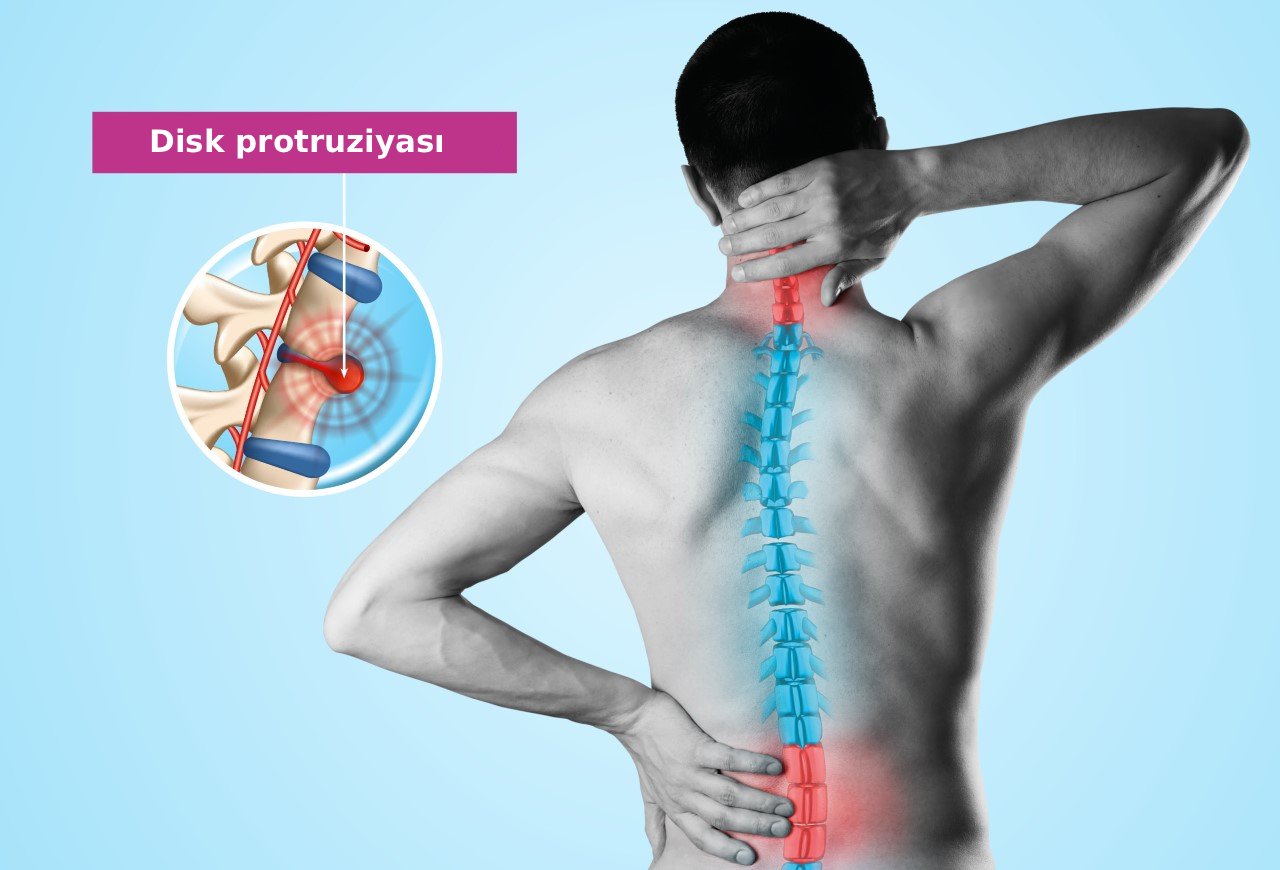 protruziya nədir əlamətləri və müalicəsi