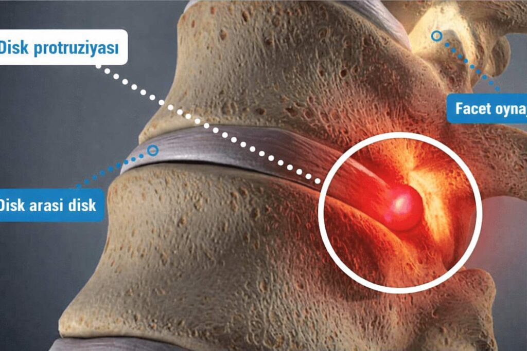 protruziya nədir və əlamətləri nələrdir